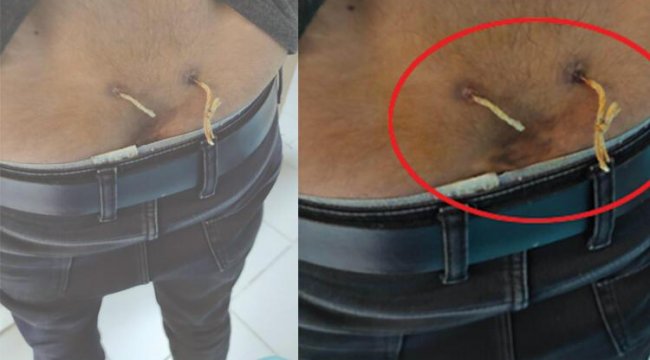 ‘Alternatif tıp’ adı altında yapılan işkencede son nokta: Çamaşır ipiyle bel tedavisi!