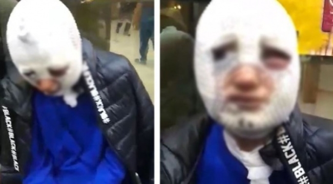 Eski sözlüsünü istismar ederek yüzüne kızgın yağ döktü