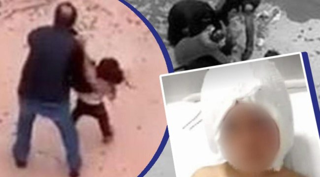 Pitbull saldırısına uğrayan Asiye'nin doktoru son sağlık durumunu açıkladı