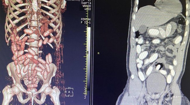 İstanbul Havalimanı'nda 7 yolcunun midesinden 11 kilo kokain çıktı